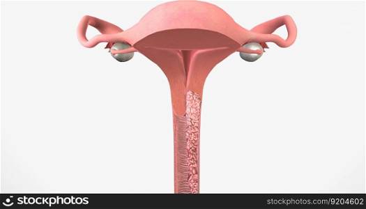 In stage III, the cancer has moved to the lower part of the vagina 3D rendering. In stage III, the cancer has moved to the lower part of the vagina