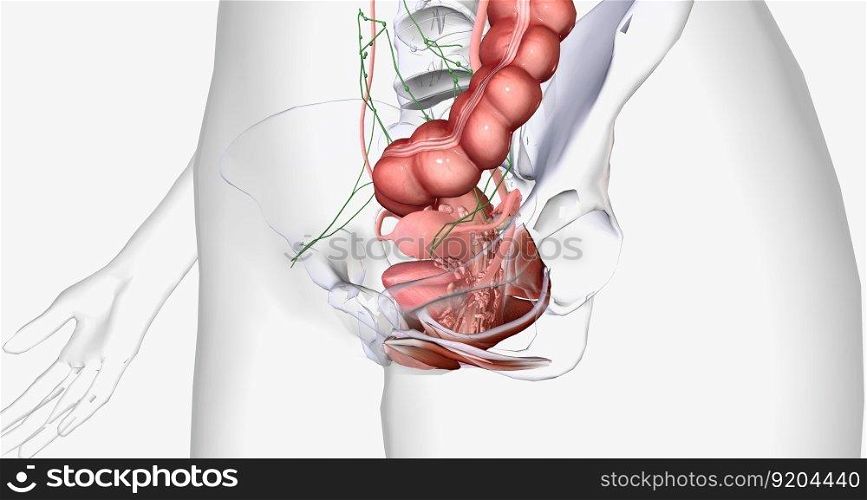 In stage IV, the cancer spreads to invade nearby organs, such as the bladder, rectum, and kidneys. 3D rendering. In stage IV, the cancer spreads to invade nearby organs, such as the bladder, rectum, and kidneys.