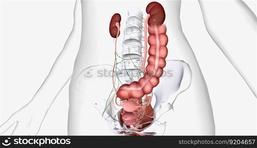 In stage IV, the cancer spreads to invade nearby organs, such as the bladder, rectum, and kidneys. 3D rendering. In stage IV, the cancer spreads to invade nearby organs, such as the bladder, rectum, and kidneys.