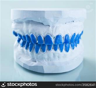 individual plaster dental molds to make trays
