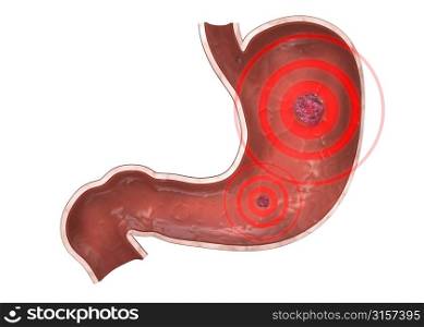 inflamed stomach
