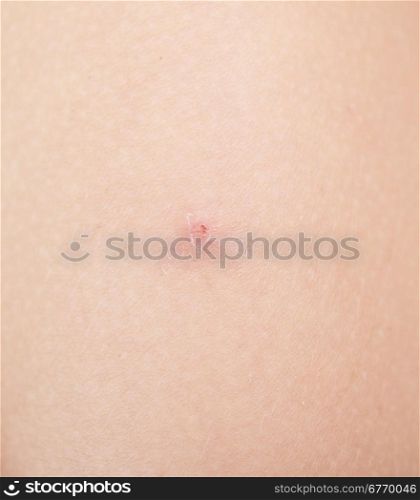 insect bite on human skin