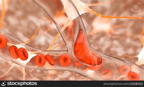 ischaemia is a restriction in blood supply to any tissues, muscle group, or organ of the body, causing a shortage of oxygen that is needed for cellular metabolism 3D illustration. Tissue responses to ischemia