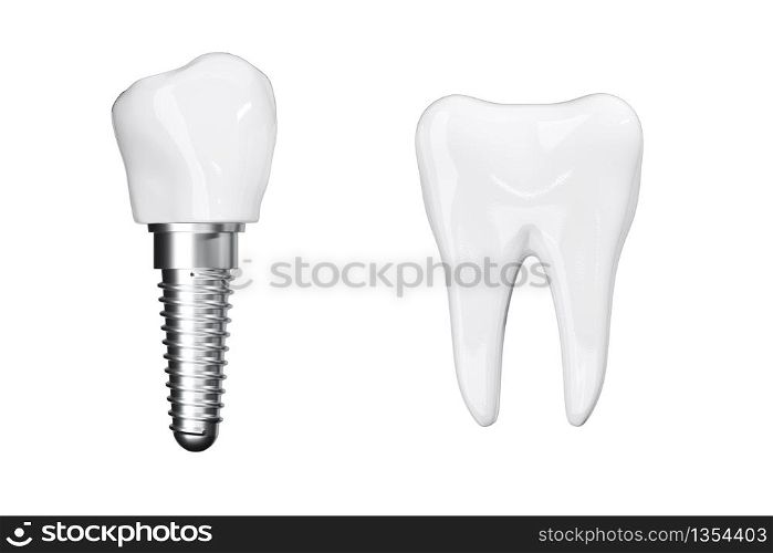 Isolate Close up Process Implants with Beauty White Teeth on white background. 3D Render