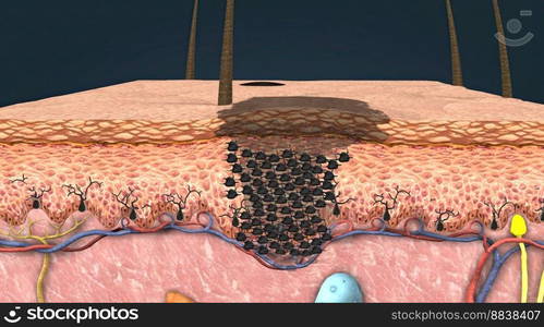 It is a skin tumor arising from melanocytes that give the skin its color. 3D illustration. It is a skin tumor arising from melanocytes that give the skin its color.