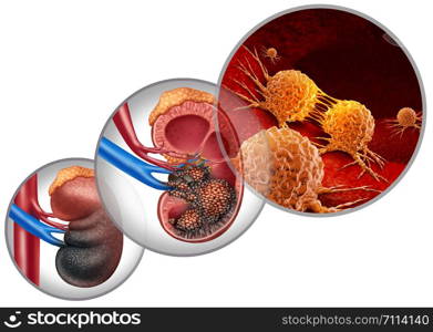 Kidney cancer disease medical concept as malignant cells in a human body attacking the urinary system and renal carcinoma anatomy as a symbol for tumor growth treatment and risk with 3D illustration elements.