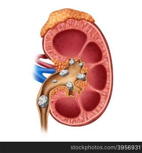 Kidney stones medical concept as a human organ with painful crystaline mineral formations as a medical symbol with a cross section as a 3D illustration style.