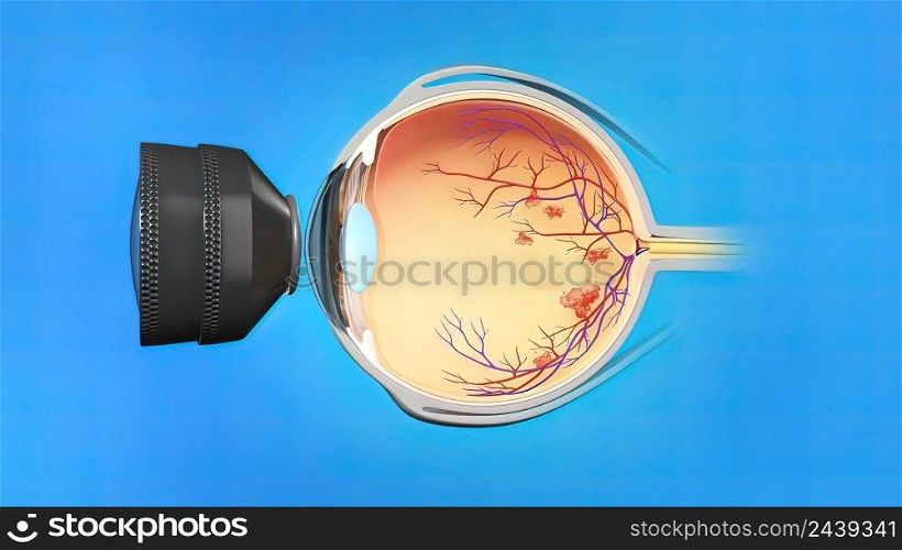 Laser surgery , eye laser treatment 3D illustration. Laser surgery , eye laser treatment