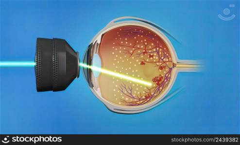 Laser surgery , eye laser treatment 3D illustration. Laser surgery , eye laser treatment