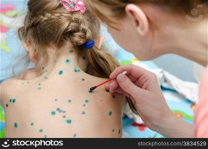 Lubrication zelenkoj chickenpox sores on the back of a little girl. Mom misses girl zelenkoj rash of chickenpox