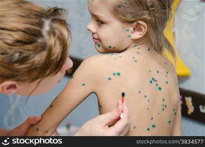 Lubrication zelenkoj chickenpox sores on the back of a little girl. Little girl with chickenpox sores smeared zelenkoj