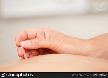 Macro detail of a female hand placing a goshin acupuncture needle in the back