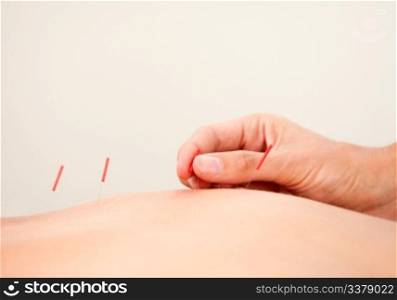 Macro detail of a hand stimulating acupuncture needles along the back