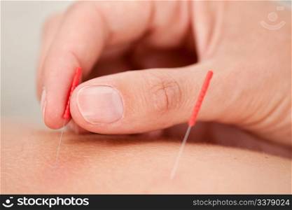 Macro detail of a hand stimulating an acupuncture needle on the back of a patient