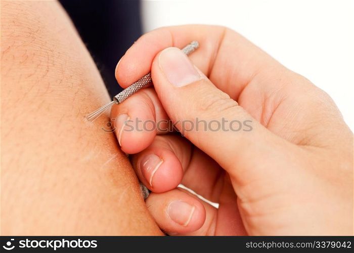 Macro detail of a shonishin acupuncture brush being used on a young boy&rsquo;s leg