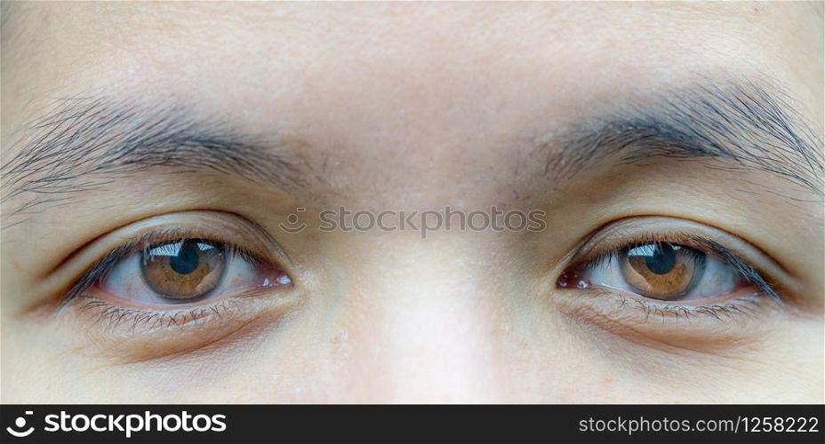 Macro shot of Asian middle aged woman brown eyes with wrinkles under the eyes and showing veins in eyes. Eyelid problem need surgery for lift up