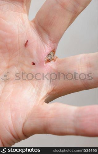 Man injured by dog bites in the hand. The deep wound left by the fangs between the fingers are obvious.