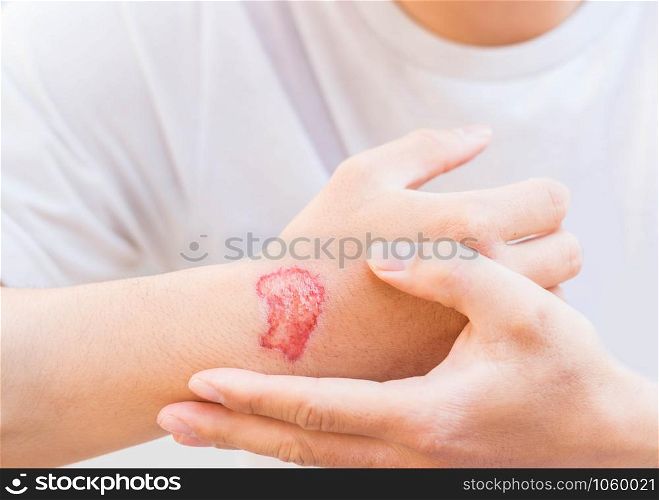 Man show red lesion or wound on his arm after accident