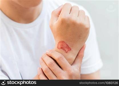 Man show red lesion or wound on his arm after accident,
