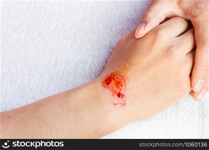 Man show red lesion or wound on his arm after accident
