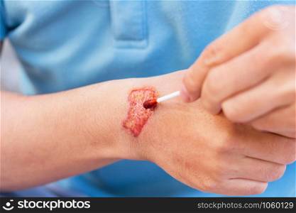 Man treat lesion or wound on his arm with red medicine after accident