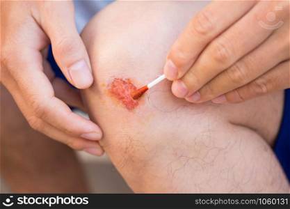 Man treat lesion or wound on his knee with red medicine after accident