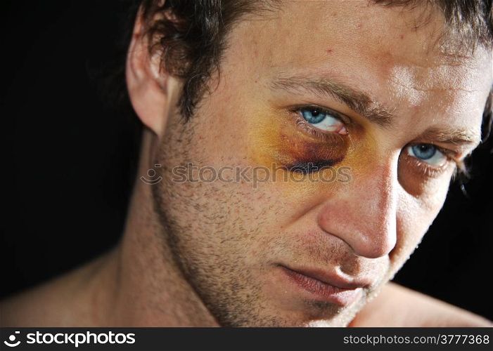 Man with an injured eye. Closeup.