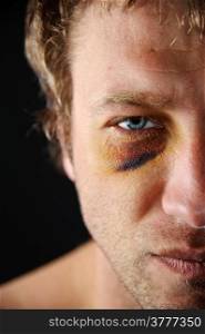 Man with an injured eye. Closeup, half face.