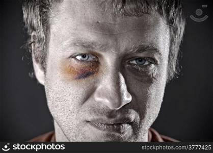 Man with an injured eye. Closeup, toned.
