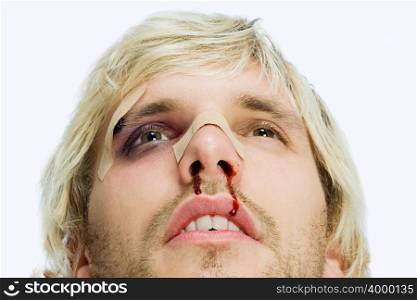 Man with black eye and bleeding nose