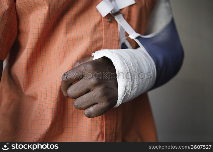 Man with broken arm, close-up of cast