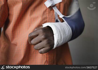Man with broken arm, close-up of cast