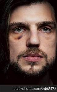 Man with bruise black eye shiner hematoma. Domestic violence male victim concept.