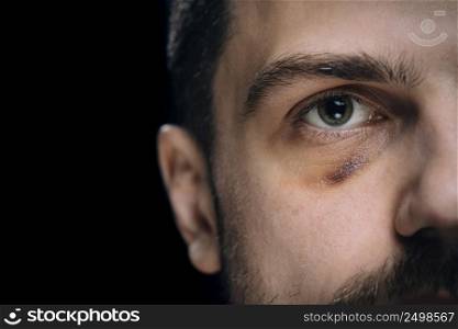 Man with bruise eye hematoma. Wounded victim with black eye.