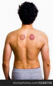 Man with marks from cupping therapy