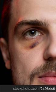 Man with shiner bruise black eye hematoma