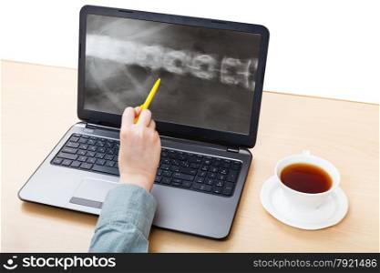 medic analyzes X-ray picture of spine on laptop screen