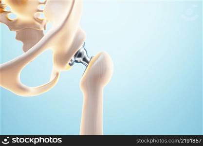 Medical poster image of a hip implant. artificial joint, Arthritis, inflammation, fracture, cartilage. 3D illustration, 3D render. Medical poster image of a hip implant. artificial joint, Arthritis, inflammation, fracture, cartilage. 3D illustration, 3D render.