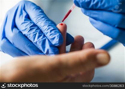 Medical technician EMS doctor taking finger prick PRP patient blood sample using pipette,Coronavirus COVID-19 global pandemic crisis outbreak,UK NHS rapid strep diagnostic antibody testing procedure
