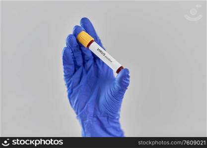medicine, healthcare and pandemic concept - close up of hand in protective medical glove holding beaker with positive virus blood test. hand holding beaker with positive virus blood test