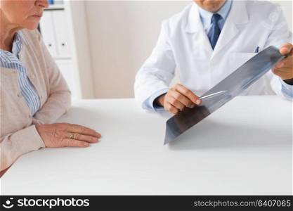 medicine, healthcare and people concept - close up of doctor showing x-ray scan to senior woman at hospital. senior woman and doctor with x-ray at hospital
