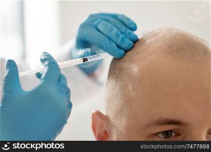 medicine, mesotherapy and cosmetic surgery concept - close up of cosmetologist&rsquo;s or doctors&rsquo;s hands with syringe making injection of hair growth serum to bald male head skin. close up of hands with syringe and bald male head