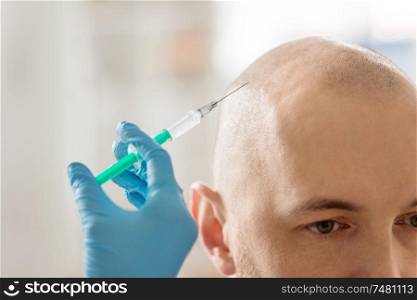 medicine, mesotherapy and cosmetic surgery concept - close up of cosmetologist&rsquo;s or doctors&rsquo;s hands with syringe making injection of hair growth serum to bald male head skin. close up of hands with syringe and bald male head