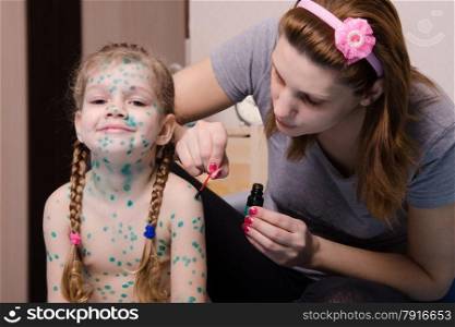 Mom misses zelenkoj sores on the body of a child suffering from chickenpox. Mom misses the little girl with chickenpox sores zelenkoj