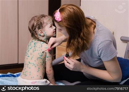 Mom misses zelenkoj sores on the body of a child suffering from chickenpox. Girl suffering from chickenpox sores mom misses zelenkoj