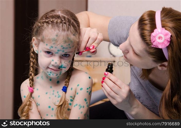 Mom misses zelenkoj sores on the face of a child suffering from chickenpox. Mom cauterize zelenkoj chickenpox rash in a child