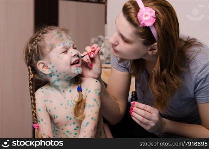 Mom misses zelenkoj sores on the face of a child suffering from chickenpox. Mom smears child with chickenpox sores zelenkoj