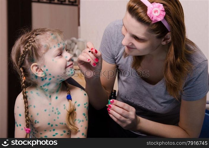 Mom misses zelenkoj sores on the face of a child suffering from chickenpox. Mama misses the child with chickenpox sores zelenkoj