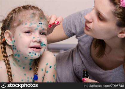 Mom misses zelenkoj sores on the face of a child suffering from chickenpox. Mom misses zelenkoj rash on face of child with chickenpox