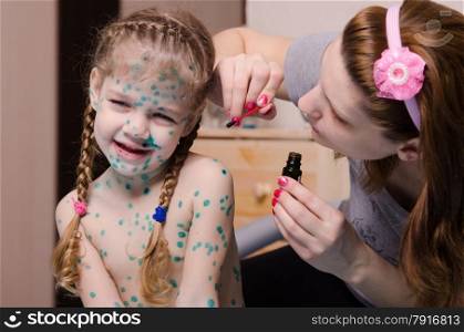 Mom misses zelenkoj sores on the face of a child suffering from chickenpox. Mom tries to smear zelenkoj rash in child with chickenpox